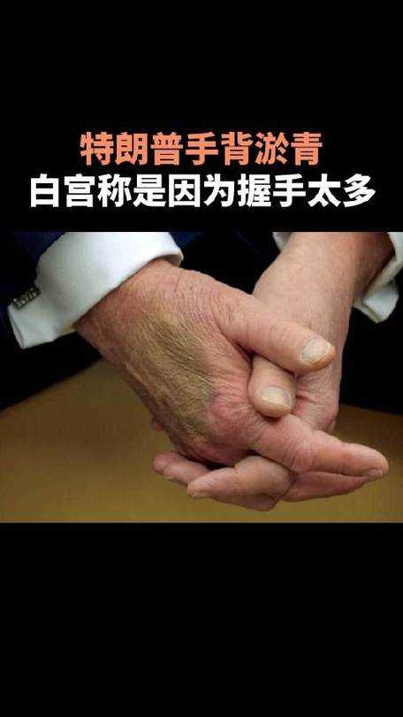 特朗普手背抹遮瑕膏 白宫:握手太多